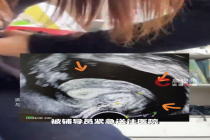 女孩洗澡搓腹后腹腔出血达上千毫升 医生提醒