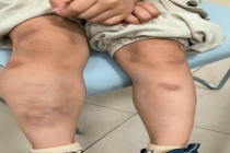 男童吃生菜包肉后全身现大片青斑 警惕寄生虫感染风险