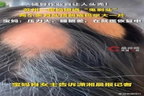 85后宝妈辅导作业遭遇鬼剃头 压力山大导致斑秃