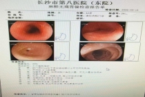 女子吃火锅太急食管烫出8厘米溃疡 高温食物惹祸