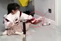 女孩玩拼豆烧伤 妈妈：这是隐形炸弹 安全隐患需警惕