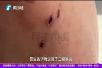 女子被流浪狗咬伤后狗死了 狂犬病阳性引发担忧