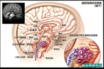 禁区“拆弹”！南京脑科医院成功完成多例高难度脑干血管瘤手术