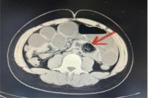 少年吃大半盘春笋后腹痛确诊肠梗阻 过量食用需谨慎