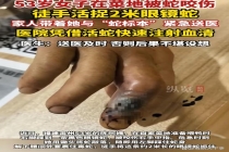 53岁阿姨被眼镜蛇咬伤后 徒手擒蛇 冷静自救教科书