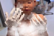 男孩玩灭火毯全身扎满玻璃纤维 细小纤维难清除