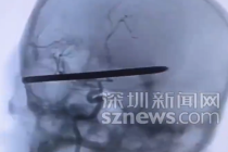 除草机弹起18cm钢钻刺穿男子头颅：医生手术4小时取出