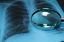 这4种癌症早期筛查真的有用 科学防癌早知道