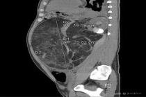 10.4公斤肿瘤破裂医生“拆弹” 多学科协作保肾成功