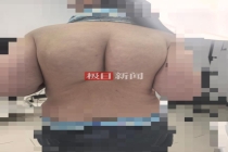 女子狂减50斤 后背被勒出两个硬包袱 紧身衣惹祸