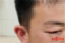 男子钓鱼甩钩不慎刺入右眼皮 消防紧急救援
