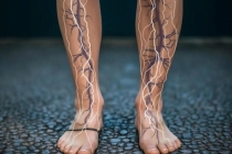 浙江大伯蚯蚓腿被胶水粘好了 不开刀不打麻药治愈