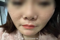 女子流了6年鼻涕竟是脑脊液 外伤手术埋隐患